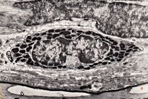 M,3y. | mast cell - n. suralis, Krabbe globoid leukodystrophy
